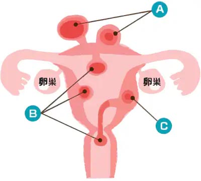 子宮筋腫の説明イラスト